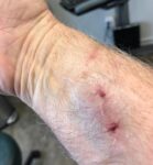 Larry got bitten
